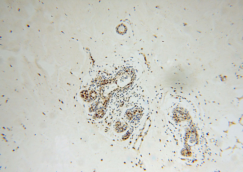 Immunohistochemical of paraffin-embedded human colon cancer using Catalog No:116876(XRCC5 antibody) at dilution of 1:100 (under 10x lens)