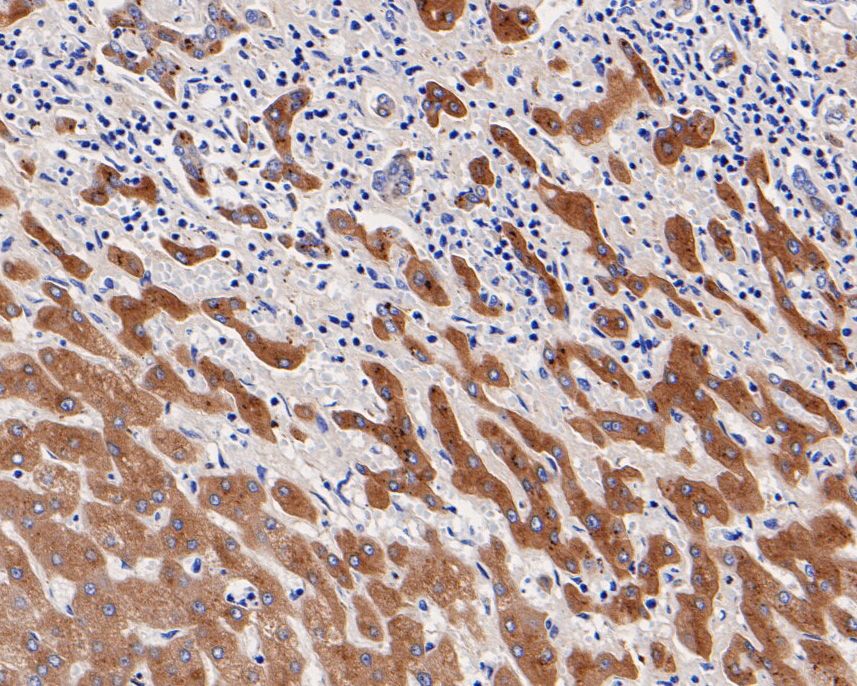 Fig5:; Immunohistochemical analysis of paraffin-embedded human liver tissue using anti-Alpha-2-macroglobulin antibody. The section was pre-treated using heat mediated antigen retrieval with Tris-EDTA buffer (pH 8.0-8.4) for 20 minutes.The tissues were blocked in 5% BSA for 30 minutes at room temperature, washed with ddH; 2; O and PBS, and then probed with the primary antibody ( 1/500) for 30 minutes at room temperature. The detection was performed using an HRP conjugated compact polymer system. DAB was used as the chromogen. Tissues were counterstained with hematoxylin and mounted with DPX.