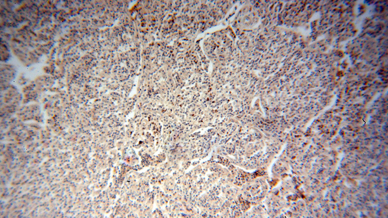 Immunohistochemical of paraffin-embedded human lymphoma using Catalog No:116351(TRAV20 antibody) at dilution of 1:50 (under 10x lens)