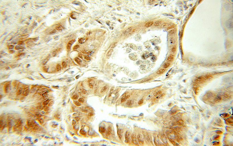 Immunohistochemical of paraffin-embedded human cervical cancer using Catalog No:115434(SMARCD2 antibody) at dilution of 1:50 (under 10x lens)
