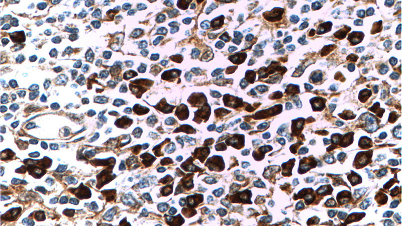 Immunohistochemistry of paraffin-embedded human tonsillitis tissue slide using Catalog No:111748(IL6 Antibody) at dilution of 1:200 (under 40x lens)
