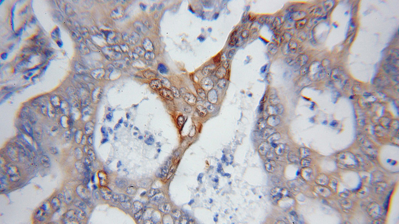 Immunohistochemical of paraffin-embedded human colon cancer using Catalog No:114397(PSMD14 antibody) at dilution of 1:50 (under 10x lens)