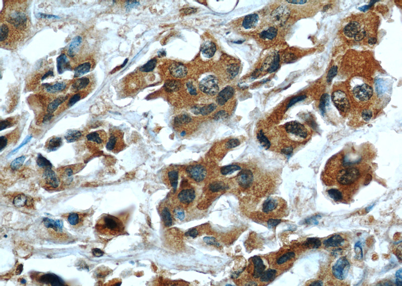 Immunohistochemical of paraffin-embedded human breast cancer using Catalog No:107246(ECM1 antibody) at dilution of 1:50 (under 40x lens)