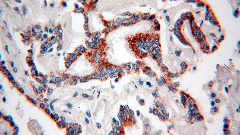 Immunohistochemical of paraffin-embedded human lung cancer using Catalog No:107411(MAGEA3 antibody) at dilution of 1:50 (under 40x lens)