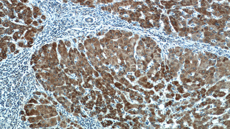Immunohistochemistry of paraffin-embedded human hepatocirrhosis tissue slide using Catalog No:111949(ITIH4 Antibody) at dilution of 1:50 (under 10x lens)