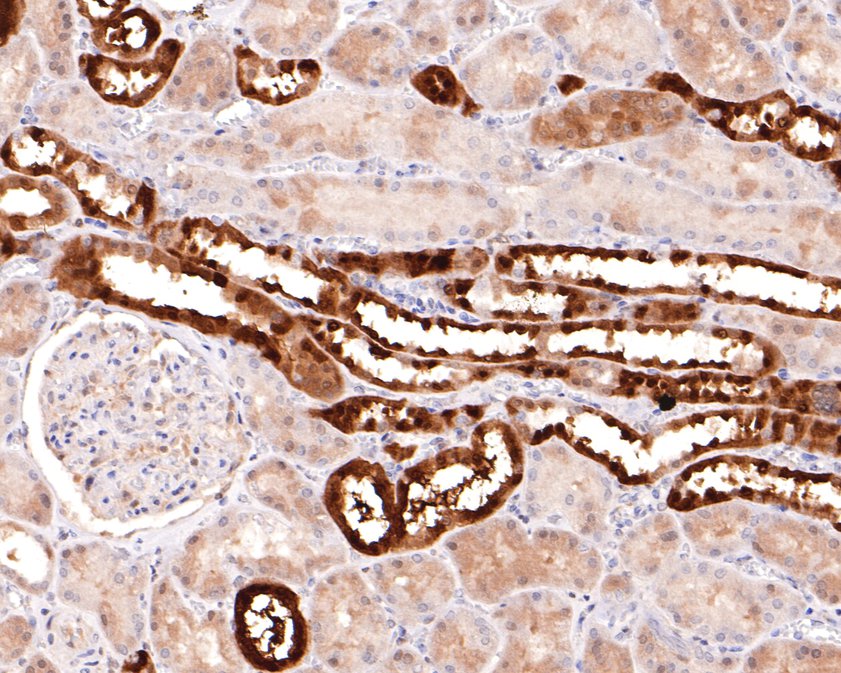 Fig2:; Immunohistochemical analysis of paraffin-embedded human kidney tissue using anti-Parvalbumin antibody. The section was pre-treated using heat mediated antigen retrieval with sodium citrate buffer (pH 6.0) for 20 minutes. The tissues were blocked in 1% BSA for 30 minutes at room temperature, washed with ddH; 2; O and PBS, and then probed with the primary antibody ( 1/400) for 30 minutes at room temperature. The detection was performed using an HRP conjugated compact polymer system. DAB was used as the chromogen. Tissues were counterstained with hematoxylin and mounted with DPX.