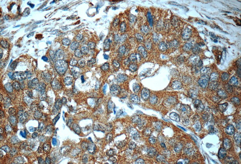 Immunohistochemistry of paraffin-embedded human cervical cancer tissue slide using Catalog No:111869(IFNG Antibody) at dilution of 1:50 (under 40x lens)