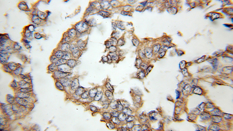 Immunohistochemical of paraffin-embedded human breast cancer using Catalog No:110328(ENT1 antibody) at dilution of 1:100 (under 10x lens)
