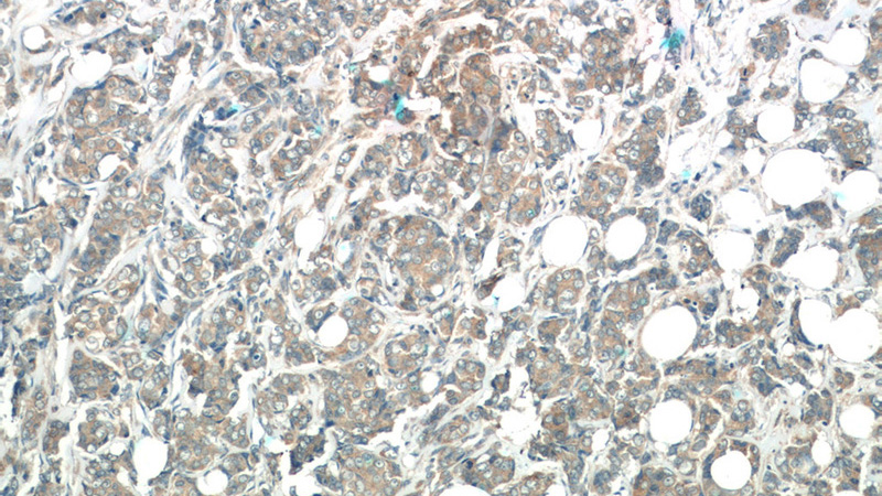 Immunohistochemistry of paraffin-embedded human breast cancer tissue slide using Catalog No:116821(WFDC1 Antibody) at dilution of 1:50 (under 10x lens)