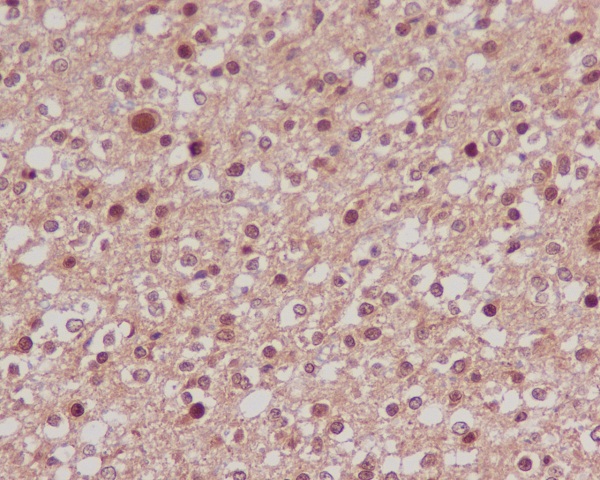 Immunohistochemical analysis of paraffin-embedded human brain carcinoma, using FoxO1a Antibody.