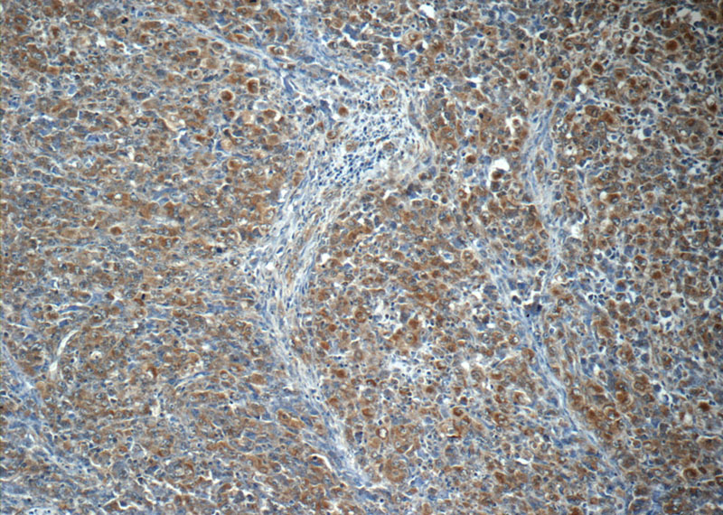 Immunohistochemistry of paraffin-embedded human lymphoma tissue slide using Catalog No:107983(ALK,CD246 Antibody) at dilution of 1:50 (under 10x lens)