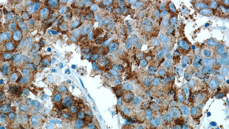 Immunohistochemical of paraffin-embedded human prostate cancer using Catalog No:107987(p504S,AMACR antibody) at dilution of 1:50 (under 40x lens). Heat mediated antigen retrieved with Citric acid buffer, pH6.0