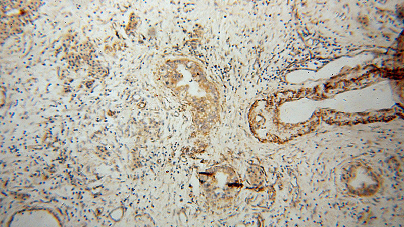 Immunohistochemical of paraffin-embedded human pancreas cancer using Catalog No:115161(SFXN3 antibody) at dilution of 1:100 (under 10x lens)