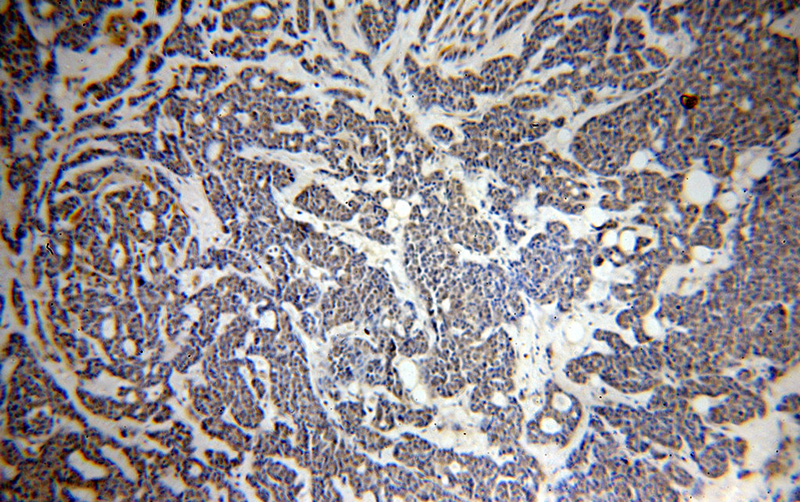 Immunohistochemical of paraffin-embedded human cervical cancer using Catalog No:113423(ORC6L antibody) at dilution of 1:100 (under 10x lens)