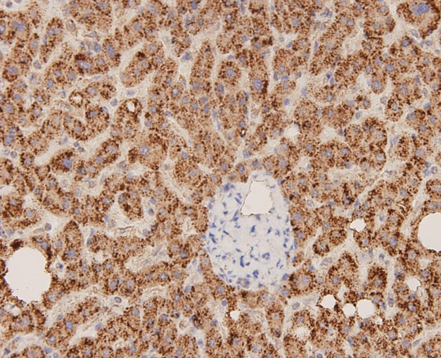 Fig2: Immunohistochemical analysis of paraffin-embedded human liver carcinoma tissue using anti-ERAS antibody. The section was pre-treated using heat mediated antigen retrieval with Tris-EDTA buffer (pH 8.0-8.4) for 20 minutes.The tissues were blocked in 5% BSA for 30 minutes at room temperature, washed with ddH2O and PBS, and then probed with the antibody at 1/100 dilution, for 30 minutes at room temperature and detected using an HRP conjugated compact polymer system. DAB was used as the chrogen. Counter stained with hematoxylin and mounted with DPX.