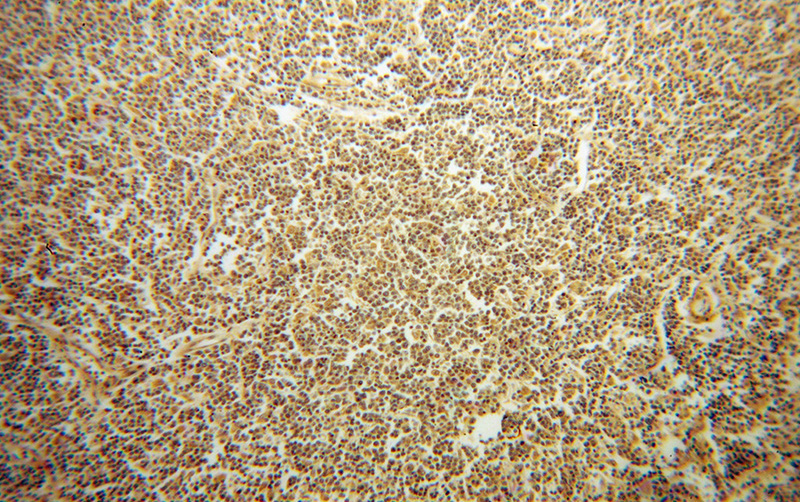 Immunohistochemical of paraffin-embedded human lymphoma using Catalog No:111161(GRAP antibody) at dilution of 1:50 (under 10x lens)