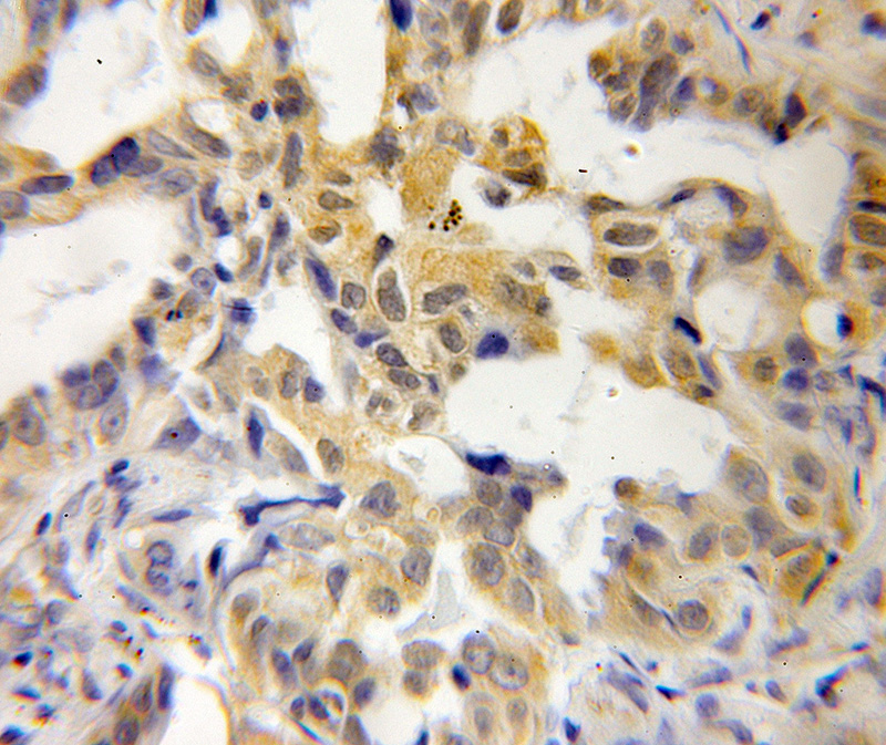 Immunohistochemical of paraffin-embedded human lung cancer using Catalog No:110250(EDN1 antibody) at dilution of 1:50 (under 25x lens)