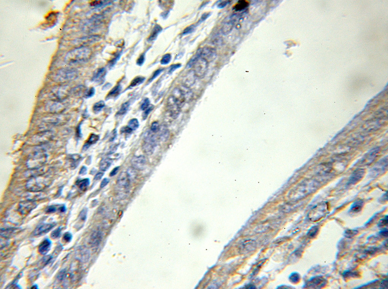 Immunohistochemical of paraffin-embedded human pancreas cancer using Catalog No:114321(PTPN4 antibody) at dilution of 1:50 (under 10x lens)