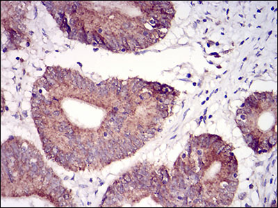 Fig3: Immunohistochemical analysis of paraffin-embedded human colon cancer tissue using anti-TUBE1 antibody. Counter stained with hematoxylin.