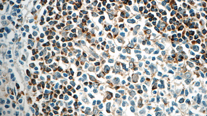 Immunohistochemistry of paraffin-embedded human tonsillitis tissue slide using Catalog No:111730(HVCN1 Antibody) at dilution of 1:200 (under 40x lens)