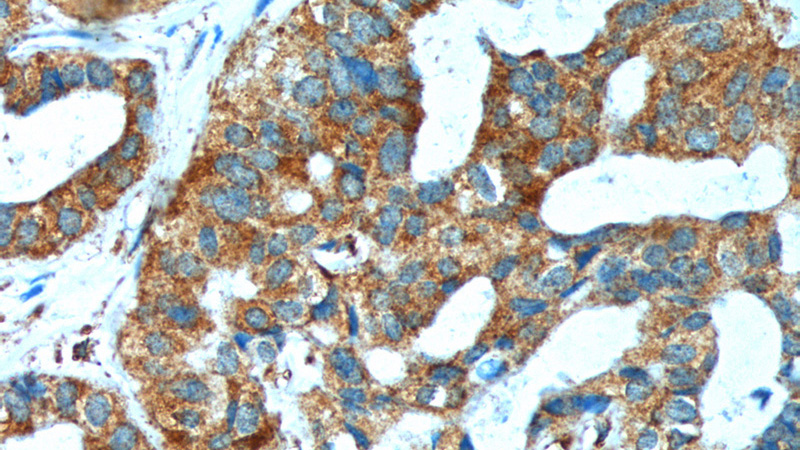 Immunohistochemistry of paraffin-embedded human breast cancer tissue slide using Catalog No:115596(SRPK1 Antibody) at dilution of 1:200 (under 40x lens).