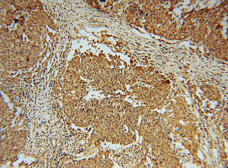 Immunohistochemical of paraffin-embedded human ovary tumor using Catalog No:113830(phospho-CHC1(Ser12) antibody) at dilution of 1:50 (under 10x lens)
