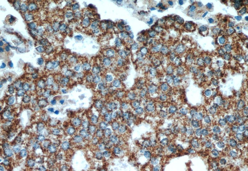 Immunohistochemical of paraffin-embedded human prostate cancer using Catalog No:115580(SPON2 antibody) at dilution of 1:50 (under 40x lens)