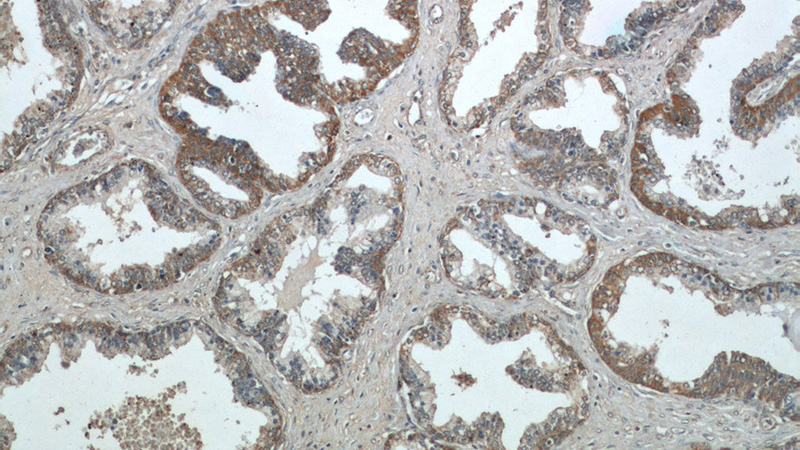 Immunohistochemical of paraffin-embedded human prostate hyperplasia using Catalog No:108721(C3orf21 antibody) at dilution of 1:50 (under 10x lens)