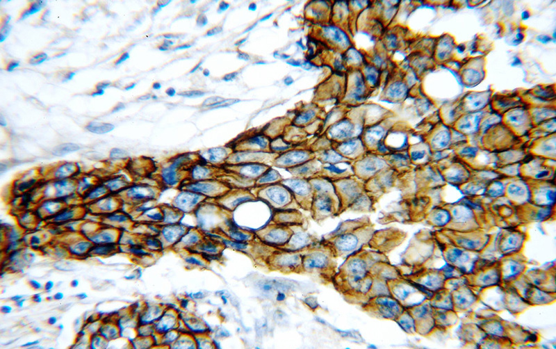 Immunohistochemical of paraffin-embedded human breast cancer using Catalog No:111294(ERBB2 antibody) at dilution of 1:50 (under 40x lens)