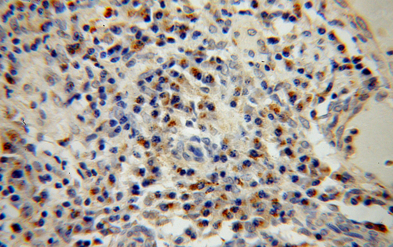 Immunohistochemical of paraffin-embedded human cervical cancer using Catalog No:117122(GS15 antibody) at dilution of 1:50 (under 40x lens)