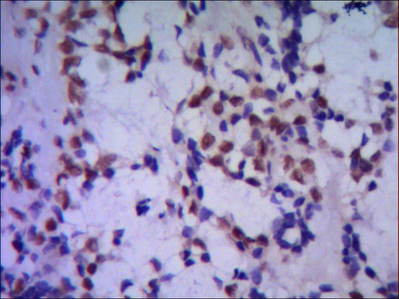 IHC of paraffin-embedded huma breast cancer using anti-TBLR1 mouse mAb diluted 1/500-1/1000