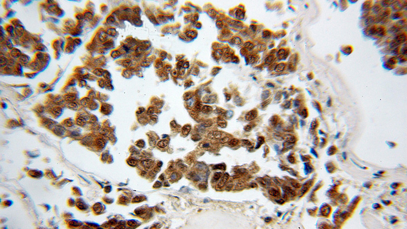 Immunohistochemical of paraffin-embedded human breast cancer using Catalog No:114150(PPP1R13L antibody) at dilution of 1:50 (under 10x lens)