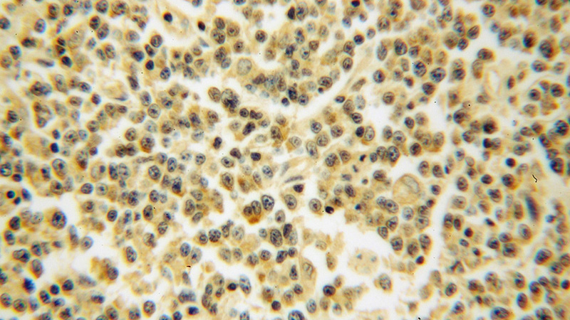 Immunohistochemical of paraffin-embedded human lymphoma using Catalog No:114826(RPS10 antibody) at dilution of 1:100 (under 40x lens)