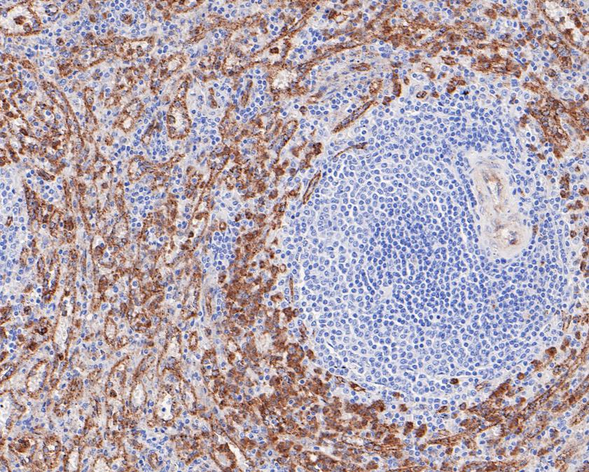 Fig3:; Immunohistochemical analysis of paraffin-embedded human spleen tissue using anti-Dysferlin antibody. The section was pre-treated using heat mediated antigen retrieval with Tris-EDTA buffer (pH 8.0-8.4) for 20 minutes.The tissues were blocked in 5% BSA for 30 minutes at room temperature, washed with ddH; 2; O and PBS, and then probed with the primary antibody ( 1/50) for 30 minutes at room temperature. The detection was performed using an HRP conjugated compact polymer system. DAB was used as the chromogen. Tissues were counterstained with hematoxylin and mounted with DPX.