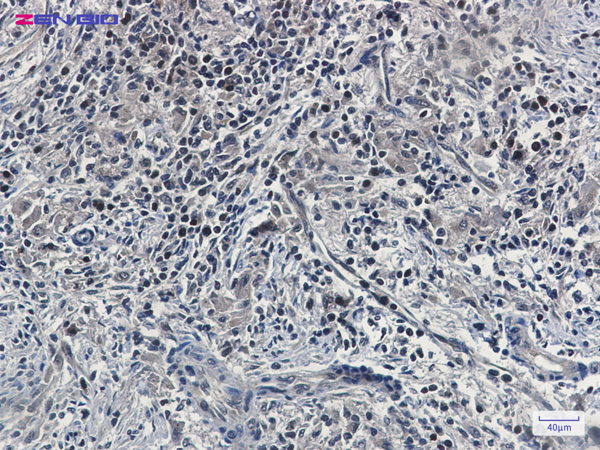 Immunohistochemistry of UFM1 in paraffin-embedded human lung cancer tissue using UFM1 Rabbit mAb at dilution 1/100