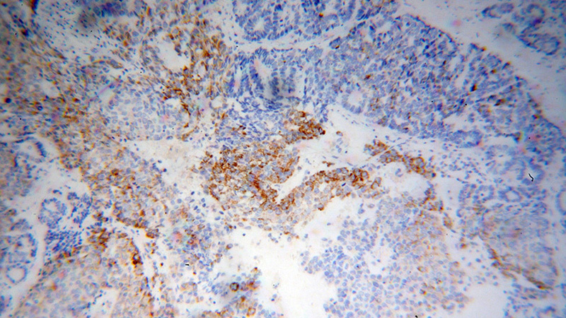 Immunohistochemical of paraffin-embedded human liver cancer using Catalog No:113647(PECR antibody) at dilution of 1:100 (under 10x lens)
