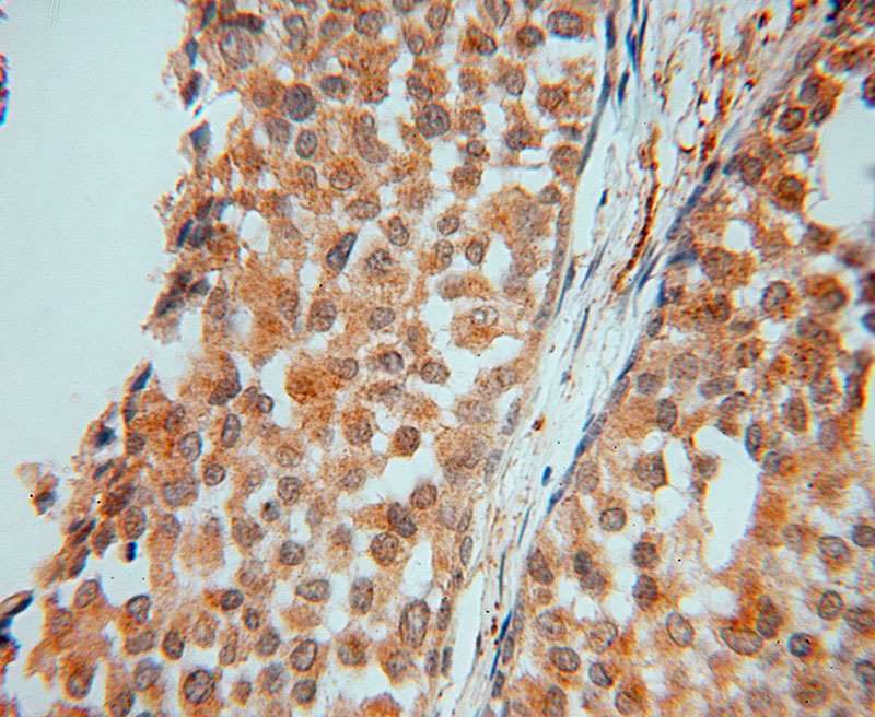 Immunohistochemical of paraffin-embedded human breast cancer using Catalog No:112371(MAEA antibody) at dilution of 1:50 (under 40x lens)