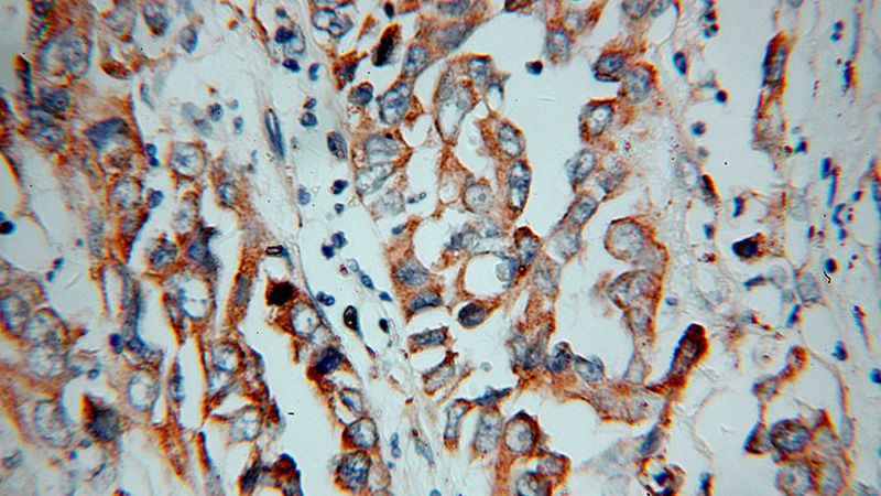 Immunohistochemical of paraffin-embedded human pancreas cancer using Catalog No:111965(KCNIP1 antibody) at dilution of 1:100 (under 40x lens)