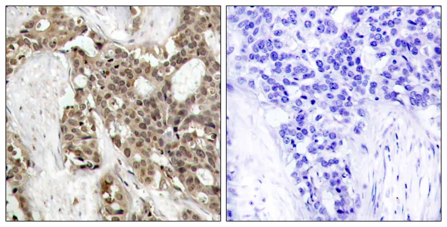 Immunohistochemical analysis of paraffin-embedded human breast carcinoma tissue using p44/42 MAP Kinase (Phospho-Tyr204) Antibody (left) or the same antibody preincubated with blocking peptide #51246 (right).