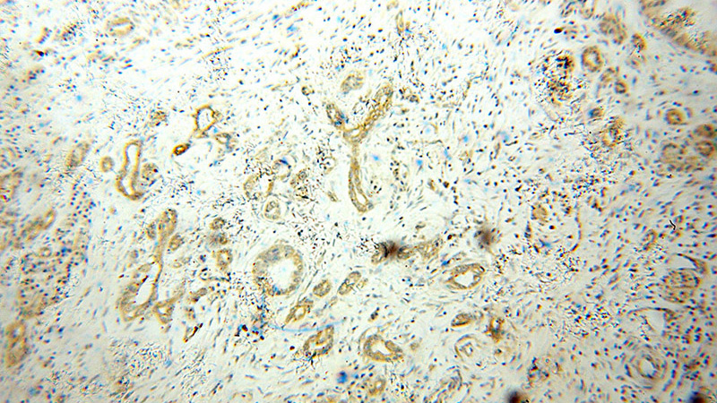 Immunohistochemical of paraffin-embedded human pancreas cancer using Catalog No:113041(NCLN antibody) at dilution of 1:50 (under 10x lens)