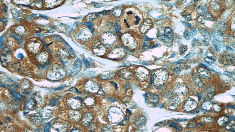 Immunohistochemistry of paraffin-embedded human breast cancer slide using Catalog No:107460(PDCD4 Antibody) at dilution of 1:50