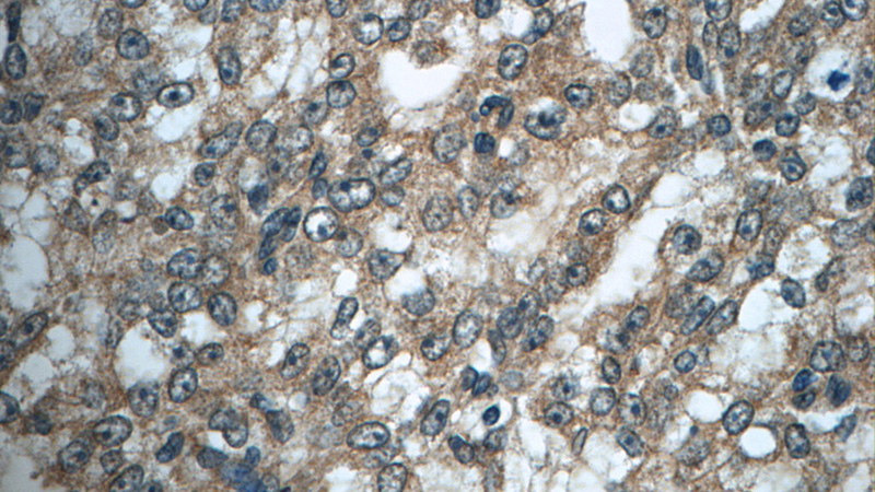 Immunohistochemistry of paraffin-embedded human prostate cancer tissue slide using Catalog No:110826(GAGE7 Antibody) at dilution of 1:50 (under 40x lens)