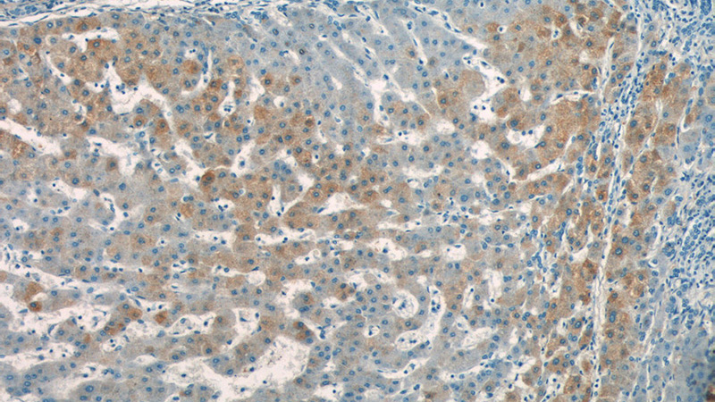Immunohistochemistry of paraffin-embedded human hepatocirrhosis tissue slide using Catalog No:108036(APOA2 Antibody) at dilution of 1:50 (under 10x lens)