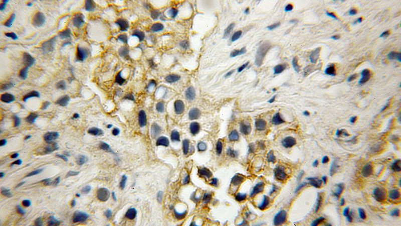 Immunohistochemical of paraffin-embedded human prostate cancer using Catalog No:115706(STEAP4 antibody) at dilution of 1:50 (under 10x lens)