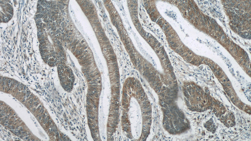 Immunohistochemistry of paraffin-embedded human colon cancer tissue slide using Catalog No:116111(TMEM190 Antibody) at dilution of 1:50 (under 10x lens)