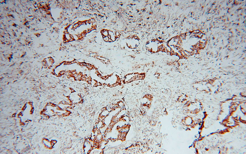 Immunohistochemical of paraffin-embedded human lung cancer using Catalog No:115374(SLC38A3 antibody) at dilution of 1:100 (under 10x lens)