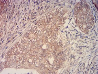 Fig4: Immunohistochemical analysis of paraffin-embedded cervical cancer tissues using anti-KMT2C antibody. The section was pre-treated using heat mediated antigen retrieval with Tris-EDTA buffer (pH 8.0) for 20 minutes. The tissues were blocked in 5% BSA for 30 minutes at room temperature, washed with ddH2O and PBS, and then probed with the primary antibody ( 1/100) for 30 minutes at room temperature. The detection was performed using an HRP conjugated compact polymer system. DAB was used as the chromogen. Tissues were counterstained with hematoxylin and mounted with DPX.