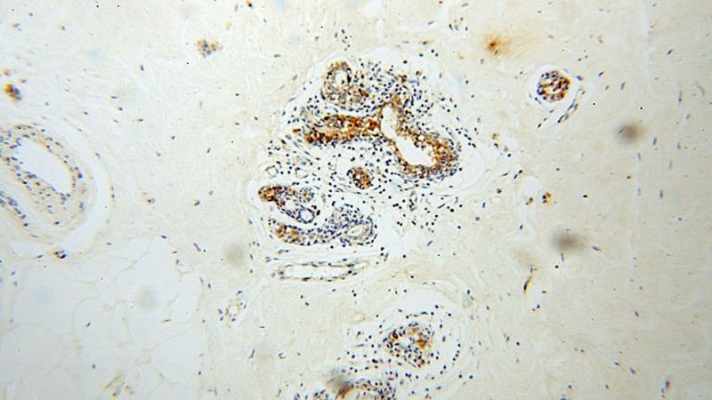 Immunohistochemical of paraffin-embedded human colon cancer using Catalog No:111317(GUSB antibody) at dilution of 1:50 (under 10x lens)