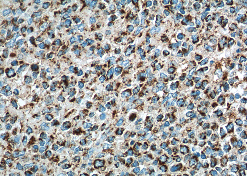 Immunohistochemistry of paraffin-embedded human tonsillitis tissue slide using Catalog No:107386(IL19 Antibody) at dilution of 1:500 (under 40x lens). heat mediated antigen retrieved with Tris-EDTA buffer(pH9).