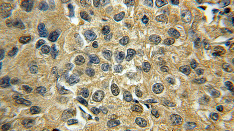 Immunohistochemical of paraffin-embedded human lung cancer using Catalog No:115814(STXBP6 antibody) at dilution of 1:50 (under 10x lens)